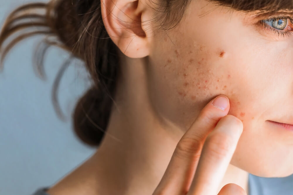 Dermatologist examining skin for acne treatment