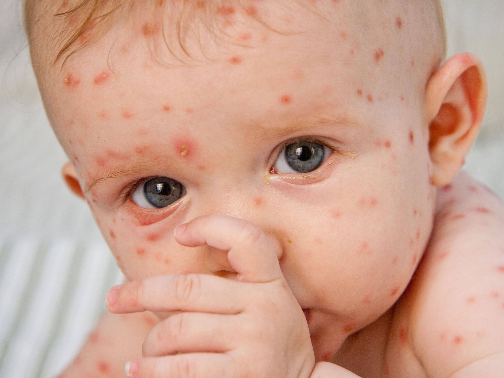 Chicken Pox Vaccinations: Keeping the Itchy Woes at Bay
