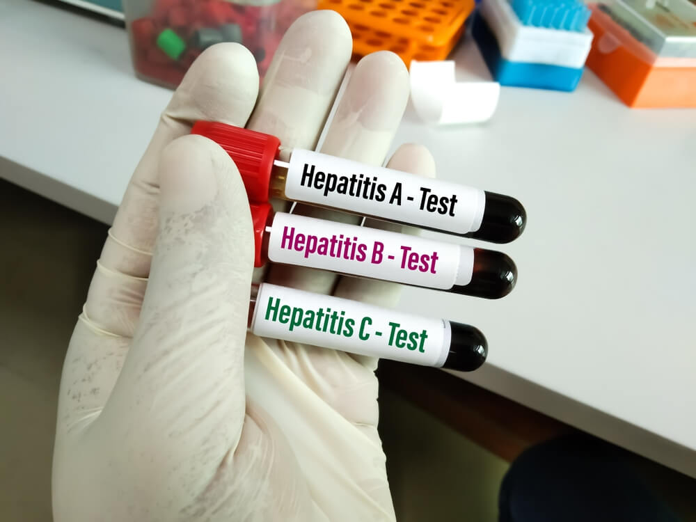 Hepatitis Testing for Liver Health at MedicPlus Health Clinic